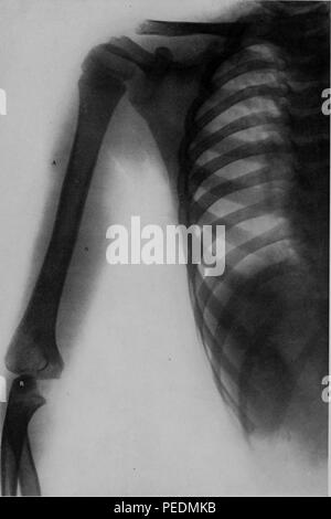 Le noir et blanc X-ray ou Rontgen Ray illustrant la cellulite de tissus du bras gauche, après une injection, dans une période de neuf ans, 1910. Avec la permission de Internet Archive. () Banque D'Images