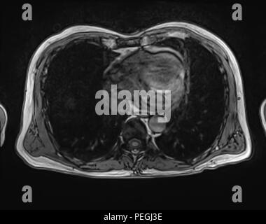 La section transversale de l'Abdomen IRM d'un patient de sexe masculin âgé de 60 ans. Ce patient souffre d'un calcul rénal Banque D'Images