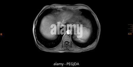 La section transversale de l'Abdomen IRM d'un patient de sexe masculin âgé de 60 ans. Ce patient souffre d'un calcul rénal Banque D'Images