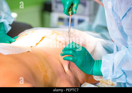 Chirurgie de liposuccion cosmétiques dans la salle d'opération, groupe de chirurgiens travaillant avec canule Banque D'Images