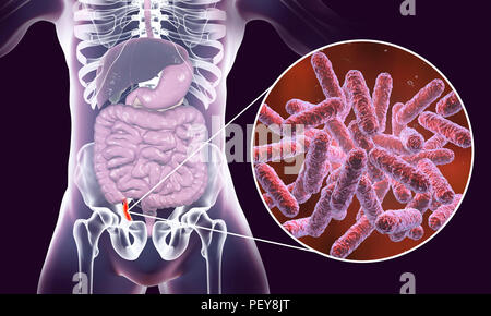 L'appendicite. Illustration d'un des droits de l'annexe, le montrant rouge et enflammée dans l'appendicite et une vue rapprochée de bactéries, les agents pathogènes de l'appendicite. Les bactéries de la famille des Enterobacteriaceae, telles que Escherichia coli, Klebsiella, Citrobacter et autres, sont les agents étiologiques les plus communes d'appendicite aiguë et chronique. Banque D'Images