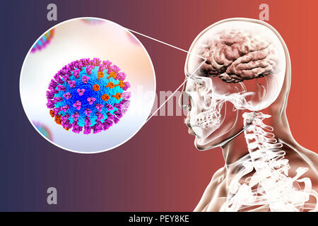 Ordinateur illustrations montrant la complication de l'infection de la grippe, comme l'encéphalite. Banque D'Images