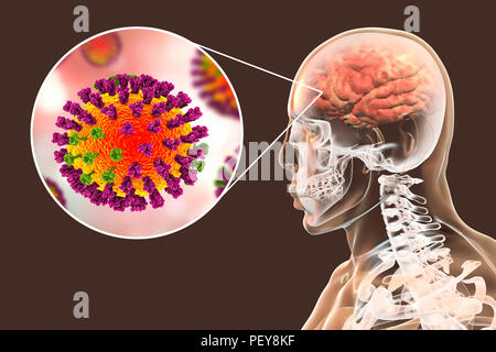 Ordinateur illustrations montrant la complication de l'infection de la grippe, comme l'encéphalite. Banque D'Images