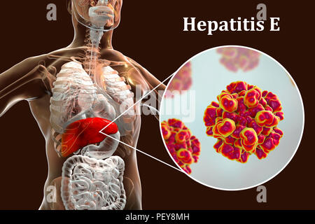 L'hépatite E L'infection. Illustration d'ordinateur montrant le foie et une vue rapprochée de l'hépatite E virus. Banque D'Images