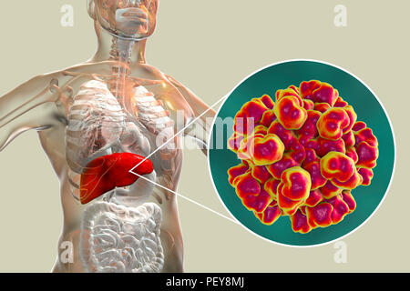 L'hépatite E L'infection. Illustration d'ordinateur montrant le foie et une vue rapprochée de l'hépatite E virus. Banque D'Images