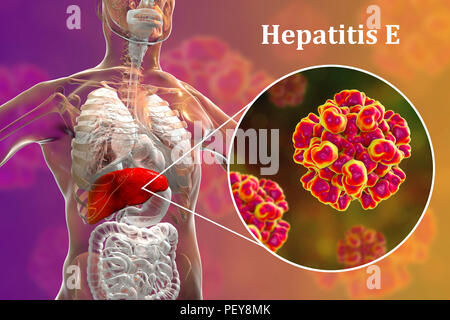 L'hépatite E L'infection. Illustration d'ordinateur montrant le foie et une vue rapprochée de l'hépatite E virus. Banque D'Images