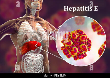 L'hépatite E L'infection. Illustration d'ordinateur montrant le foie et une vue rapprochée de l'hépatite E virus. Banque D'Images