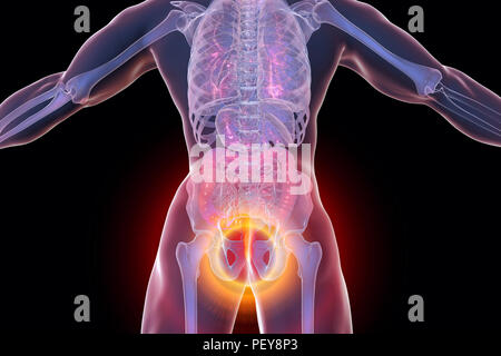 Les hémorroïdes. Illustration d'ordinateur d'une vue arrière du corps humain avec des hémorroïdes dans l'anus. Banque D'Images
