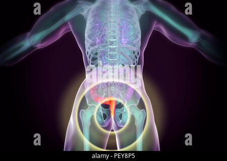 Les hémorroïdes. Illustration d'ordinateur d'une vue arrière du corps humain avec des hémorroïdes dans l'anus. Banque D'Images