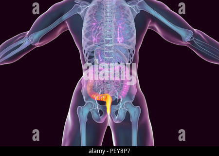 Les hémorroïdes. Illustration d'ordinateur d'une vue arrière du corps humain avec des hémorroïdes dans l'anus. Banque D'Images