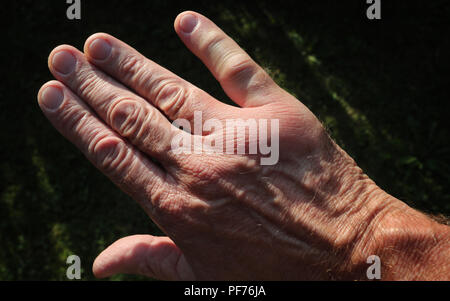 Kempten, Allemagne. 20e Août, 2018. Un petit doigt et une partie de l'arrière de la main sont enflés après une piqûre de guêpe. Credit : Karl-Josef Opim/dpa/Alamy Live News Banque D'Images