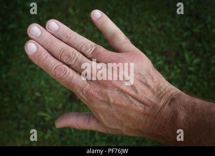 Kempten, Allemagne. 20e Août, 2018. Un petit doigt et une partie de l'arrière de la main sont enflés après une piqûre de guêpe. Credit : Karl-Josef Opim/dpa/Alamy Live News Banque D'Images