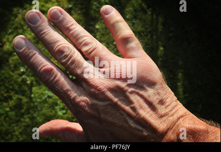 Kempten, Allemagne. 20e Août, 2018. Un petit doigt et une partie de l'arrière de la main sont enflés après une piqûre de guêpe. Credit : Karl-Josef Opim/dpa/Alamy Live News Banque D'Images