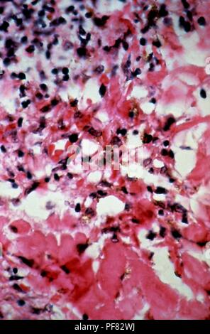 Des changements histopathologiques dans le cas du sarcome de Kaposi a révélé des lésions dans la biopsie de peau micrograph, film 1981. Image courtoisie Centres for Disease Control (CDC) / Dr Steve Kraus. () Banque D'Images