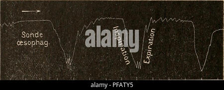 . Dictionnaire de physiologie. La physiologie. 50^¨HEMORRAGIE. biliaires côte de une partie de son contenu normal. Les deux ordres de phÃ©nomÃ ic nes¨- <lessus nous expliquent, d'une part, la discordance entre l'intensitÃ© de l'hÃ©morragie et la &Lt ; hute de la pression sanguine, et, d'autre part, la rapiditÃ© avec laquelle cette pression se rÃ©tablit, quand la perte de sang n'est pas trop forte. Â A ce point de vue, une expÃ©- rience trà s¨doiniÃ instructif de Hoche un© les rÃ©sultats suivants : La saignÃ©e a Ã©tÃ© de 0,01 du poids du corps. Pressioa avant la saignÃ©e. Il Ã 18 cm de Hg. Pression p Banque D'Images