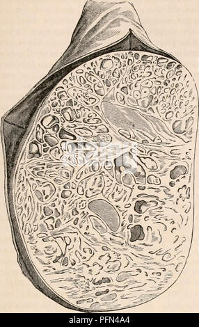 . La cyclopaedia d'anatomie et physiologie. Anatomie ; physiologie ; Zoologie. Testicule (anatomie anormale). développé sous deux formes. Dans l'un, il se produit en association avec careinomatous- : Fig. 654.. Section d'une tumeur kystique du testicule, montrant une multitude de kystes de diverses formes et tailles, avec la matière solide interposé entre eux. La structure glandulaire est icholly détruit. dans l'autre et forme plus courante, la tumeur est d'un caractère innocent, et exempts de la maladie risque de s'attaquer à d'autres parties après le retrait de l'organe. Dans l'ancien les kystes sont plus grandes et l Banque D'Images