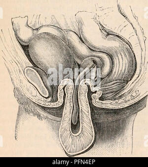 . La cyclopaedia d'anatomie et physiologie. Anatomie ; physiologie ; Zoologie. Inversion incomplète de l'utérus. (D'après J. G. Forbes.) le fundus commence à dépasser par l'os de l'utérus, glisser après il les trompes de Fallope, qui sont tirés dans le creux formé par les organe. dilatation de l'utérus d'une tumeur de la taille d'un abricot aplati, qui s'est ex- pelled au moment où l'utérus est entrée Fig. 471.. Inversion totale de l'utérus. (Diagramme.) vers le bas complètement renversé,-l'ac- tion violente des muscles abdominaux et du diaphragme probablement ici à la production ou à l'aide Banque D'Images