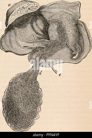 . La cyclopaedia d'anatomie et physiologie. Anatomie ; physiologie ; Zoologie. Ovaire- (anatomie anormale). 585 de la position, la consistance et l'aspect de saindoux ou de beurre, au milieu de laquelle sont intégrés les bobines de cheveux avec laquelle il est généralement associé (Jig. 397. (I). Ce matériau gras est d'une teinte jaunâtre ou blanc, et est communément inodorous, mais parfois, il ex- hales intolérablement une odeur fétide, en particulier dans les cas où l'air a été admis dans le sac, et la décomposition partielle a eu lieu, ou si du pus fétide a été formé au sein du kyste. La deuxième condition sous w Banque D'Images