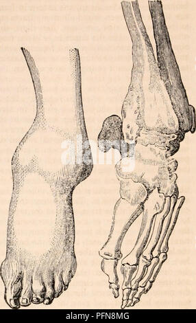 . La cyclopaedia d'anatomie et physiologie. Anatomie ; physiologie ; Zoologie. 158 CONDITION ANORMALE DE L'ARTICULATION DE LA CHEVILLE. ligaments obliques qui passent avant et être- du tibula hind au tibia. La bonne membrane interosseous lui-même doit être détachée de entre les os pour permettre à l'astragale de monter le long de l'extérieur du tibia. Tandis que les ligaments qui relient la malléole externe au tibia doit être déchirés, ceux qui s'unissent au pied restent ensemble, le deltoïde ou ligament latéral interne doit être complètement déchirés partout, ainsi que le sac synovial de l'articula- tion ; ni Banque D'Images