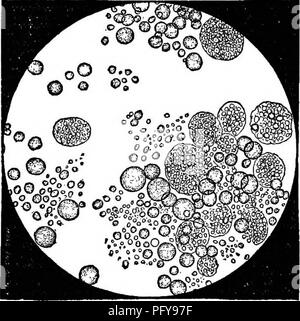 . L'analyse chimique et physique de lait, lait concentré, lait pour nourrissons et aliments, avec une attention particulière à l'hygiène et l'inspection sanitaire du lait : un guide de laboratoire, développé à partir de l'expérience pratique, destiné aux pharmaciens, médecins, étudiants, techniciens, etc. Le lait ; les nourrissons. 67 globules de grande taille sont généralement observés après une période prolongée de soins infirmiers, et si la mère est avancé en âge, une augmentation de la taille de la globules lipidiques a également été observé, et est ensuite accompagnée par l'apparition de corpuscules de colostrum à la période de la menstruation, comme aussi en cas de maladie accompagnée Banque D'Images