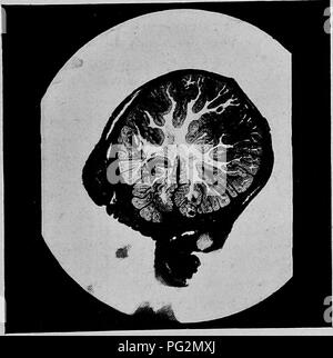 . Les maladies des organes génitaux des animaux domestiques. La médecine vétérinaire. Fig. 141 très-amplifiés. L'article de muqueuse normale de pliage. oviducte. Fig 142-Section de l'oviducte d'un Six-Weeks-veau ancien. Indiquant les Épaisseur de la muqueuse.. Veuillez noter que ces images sont extraites de la page numérisée des images qui peuvent avoir été retouchées numériquement pour plus de lisibilité - coloration et l'aspect de ces illustrations ne peut pas parfaitement ressembler à l'œuvre originale.. Williams, Walter Long, 1856-1945 ; Williams, Walter Wilkinson, 1892- coauteur. Ithaca, N. Y. , l'auteur Banque D'Images