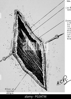 . Les coliques du cheval : leurs causes, symptômes, diagnostic et traitement . Chevaux ; coliques. 178 LA POLITIQUE DES COLIQUES DU CHEVAL DE L'abdomen. Au moyen d'une incision de la ligne blanche tout organe à l'intérieur de la cavité peut être estimé, le petit et le gros intestin dans la partie peut être vu, et à som^ point. Couper des fibres obliques externes. Deuxième incision 1 iirallel w th th.e fibres synthétiques de l'ihe dans la sterne al oblique. (Les fibres du fascia transversalis cfin être feen par l'w sound). Fig. 13 Coopération Blessure (Laparo-Enterotomy), montrant la première incision à travers la peau et dans les fibres de l'obliq externe Banque D'Images