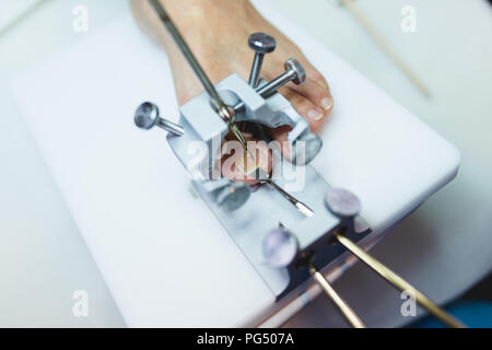 Le mycète d'un traitement par laser à pied ongle laser therapy clinic. Banque D'Images