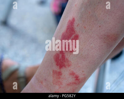 La vascularite DE JAMBES Photo Stock - Alamy