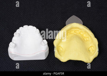 Processus de réhabilitation orale, prothèse amovible partielle Banque D'Images