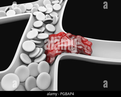 Thrombose veineuse profonde ou des caillots de sang. Embolie pulmonaire Banque D'Images