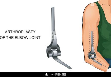 Vector illustration de l'endoprothèse de l'articulation du coude Illustration de Vecteur