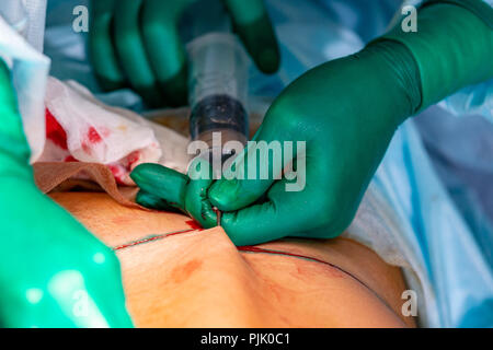 Chirurgie de liposuccion cosmétiques dans la salle d'opération, groupe de chirurgiens travaillant avec canule Banque D'Images