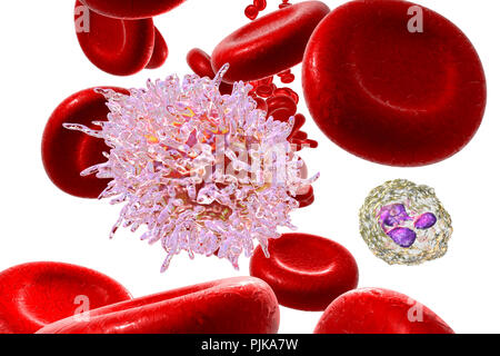 La leucémie à tricholeucocytes. Illustration d'ordinateur d'anomalies des globules blancs (lymphocytes B-) d'un patient atteint de leucémie à tricholeucocytes. Ces cellules présentent des projections cytoplasmiques des cheveux et des volants sur leurs surfaces. La leucémie est un cancer du sang dans lequel le sang des tissus de production dans la moelle osseuse produit un nombre excessif de globules blancs immatures, comme on le voit ici, qui nuisent à la fonction des cellules sanguines normales. Le système immunitaire est donc affaiblie. La leucémie à tricholeucocytes est une forme rare de leucémie qui affecte principalement les hommes. La plupart des patients survivent pendant cinq ans ou plus après le diagnostic. Banque D'Images