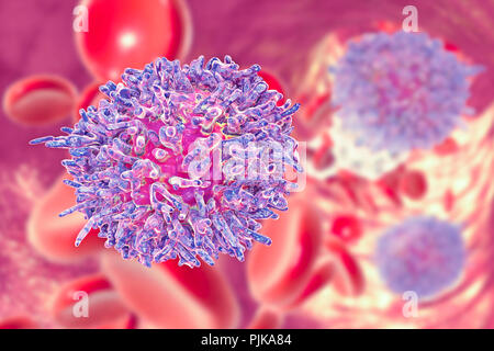 La leucémie à tricholeucocytes. Illustration d'ordinateur d'anomalies des globules blancs (lymphocytes B-) d'un patient atteint de leucémie à tricholeucocytes. Ces cellules présentent des projections cytoplasmiques des cheveux et des volants sur leurs surfaces. La leucémie est un cancer du sang dans lequel le sang des tissus de production dans la moelle osseuse produit un nombre excessif de globules blancs immatures, comme on le voit ici, qui nuisent à la fonction des cellules sanguines normales. Le système immunitaire est donc affaiblie. La leucémie à tricholeucocytes est une forme rare de leucémie qui affecte principalement les hommes. La plupart des patients survivent pendant cinq ans ou plus après le diagnostic. Banque D'Images