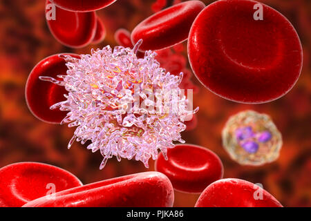 La leucémie à tricholeucocytes. Illustration d'ordinateur d'anomalies des globules blancs (lymphocytes B-) d'un patient atteint de leucémie à tricholeucocytes. Ces cellules présentent des projections cytoplasmiques des cheveux et des volants sur leurs surfaces. La leucémie est un cancer du sang dans lequel le sang des tissus de production dans la moelle osseuse produit un nombre excessif de globules blancs immatures, comme on le voit ici, qui nuisent à la fonction des cellules sanguines normales. Le système immunitaire est donc affaiblie. La leucémie à tricholeucocytes est une forme rare de leucémie qui affecte principalement les hommes. La plupart des patients survivent pendant cinq ans ou plus après le diagnostic. Banque D'Images