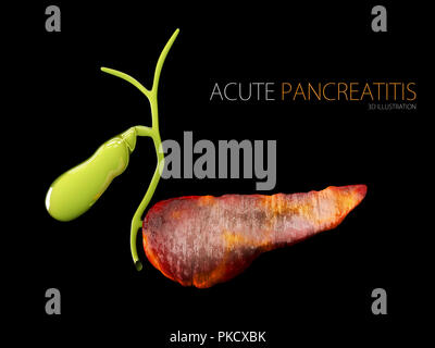 La pancréatite aiguë 3d illustration, inflammation du pancréas sur un fond noir Banque D'Images
