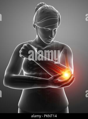 Femme avec la douleur du coude, illustration de l'ordinateur. Banque D'Images