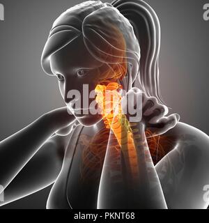 Femme avec la douleur au cou, illustration de l'ordinateur. Banque D'Images
