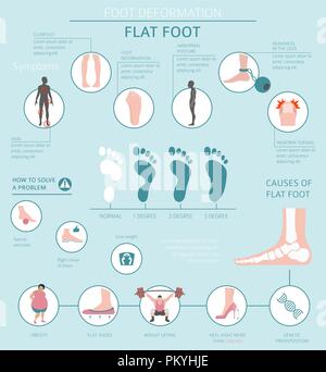 La déformation du pied en tant que maladie médicale infographie. Causes de pied plat. Vector illustration Illustration de Vecteur