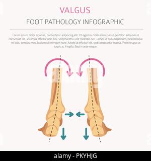 La déformation du pied en tant que maladie médicale infographie. Varus et Valgus défaut. Vector illustration Illustration de Vecteur