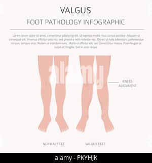 La déformation du pied en tant que maladie médicale infographie. Varus et Valgus défaut. Vector illustration Illustration de Vecteur