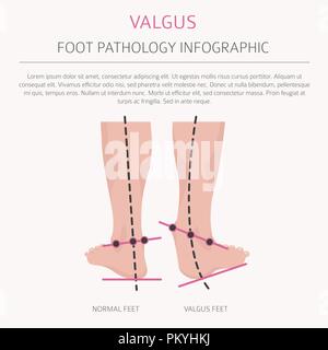 La déformation du pied en tant que maladie médicale infographie. Varus et Valgus défaut. Vector illustration Illustration de Vecteur