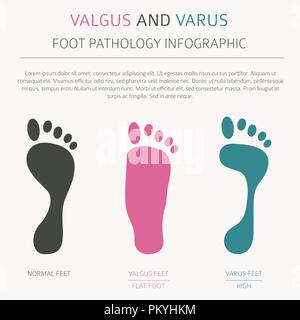 La déformation du pied en tant que maladie médicale infographie. Varus et Valgus défaut. Vector illustration Illustration de Vecteur