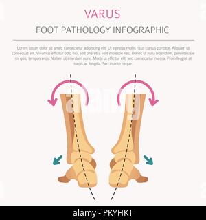 La déformation du pied en tant que maladie médicale infographie. Varus et Valgus défaut. Vector illustration Illustration de Vecteur