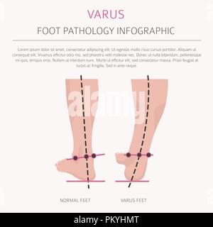 La déformation du pied en tant que maladie médicale infographie. Varus et Valgus défaut. Vector illustration Illustration de Vecteur