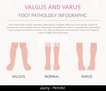 La déformation du pied en tant que maladie médicale infographie. Varus et Valgus défaut. Vector illustration Illustration de Vecteur