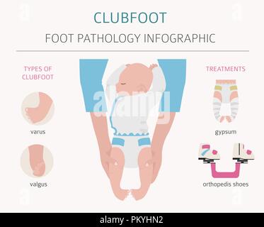 La déformation du pied, la maladie médicale infographie. Défaut de pied bot. Vector illustration Illustration de Vecteur