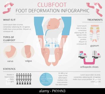 La déformation du pied, la maladie médicale infographie. Défaut de pied bot. Vector illustration Illustration de Vecteur