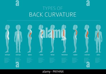 Types de courbure. La maladie médicale infographie. Vector illustration Illustration de Vecteur