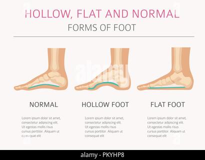 Types de déformation du pied, la maladie médicale infographie. Télévision, creux et pied normal. Vector illustration Illustration de Vecteur